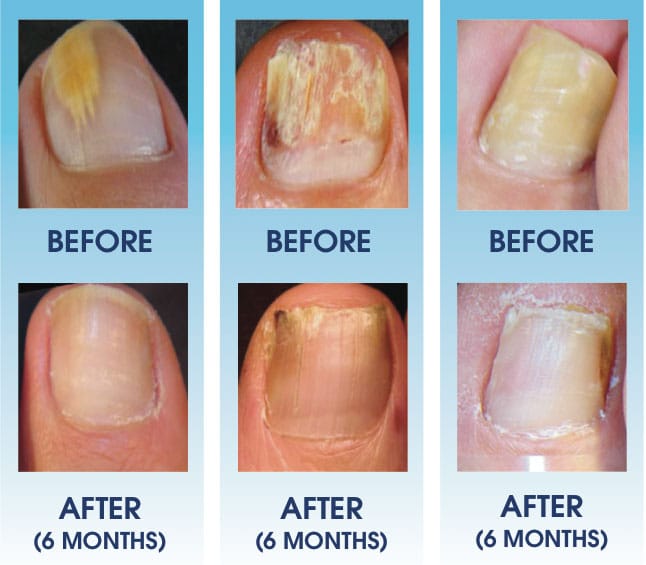 Can Acrylic nails cause Nail Fungi? | Elim Spa Products