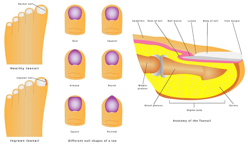 Ingrown Toenail (Onychocryptosis): Symptoms & Treatment