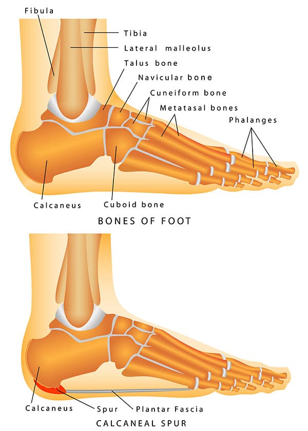 Bone Spurs - North York and Toronto Foot Doctor