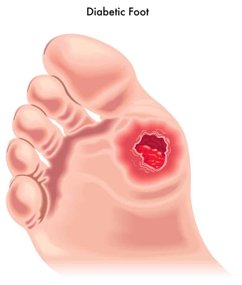 Diabetic Ulcers Mellitus Foot Feet Clinic Issues