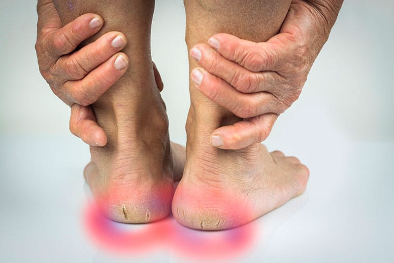 Cracked Heels: Understanding Causes | Gait Happens