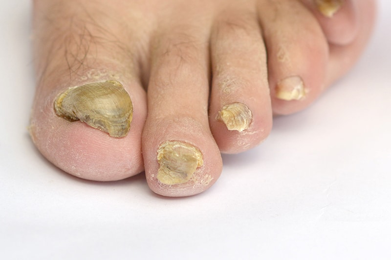 Types of Toenail Fungus: Pictures, Symptoms, and Treatment