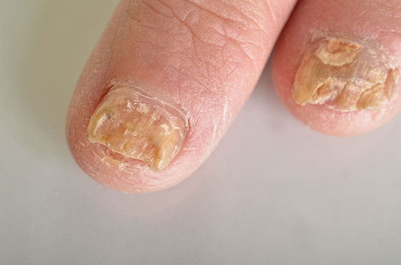 Dollar General Antifungal Nail Solution